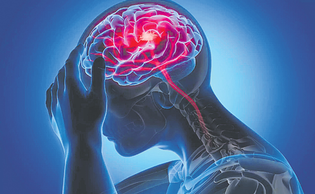 BRAIN-STROKE.jpg