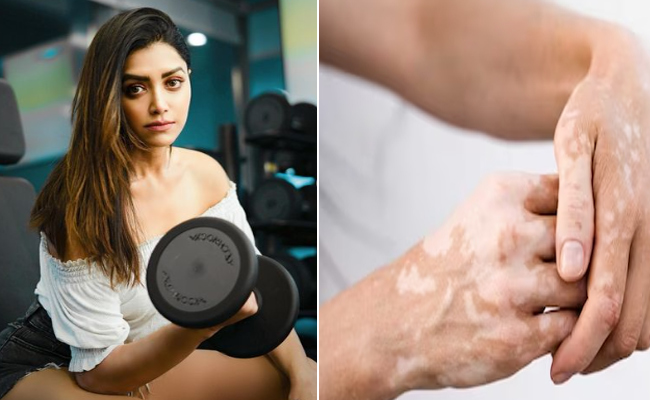 vitiligo.jpg