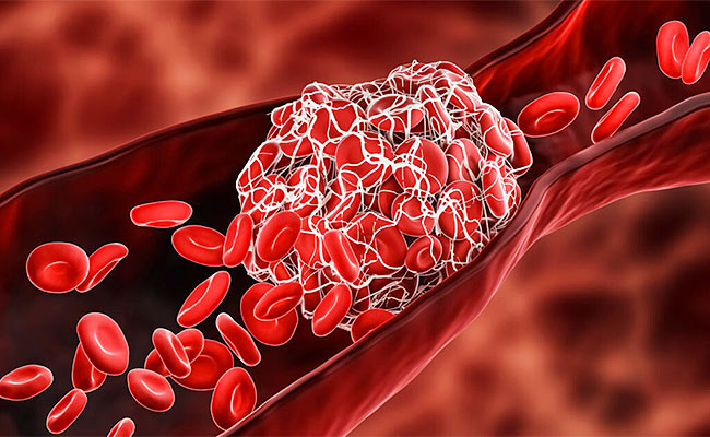 Blood-Clot.jpg