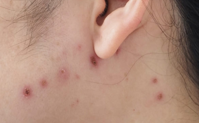 chicken-pox.jpg