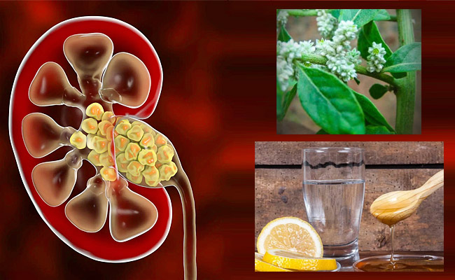 Kidney-Stones.jpg
