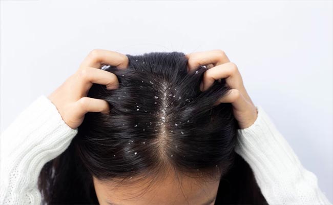 dandruff.jpg
