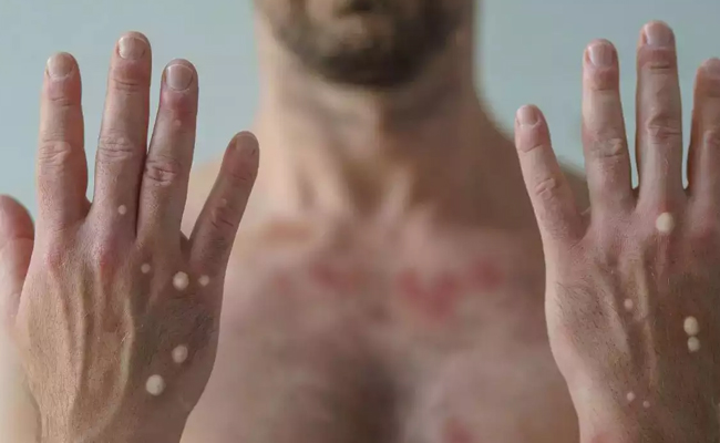 small-pox.jpg