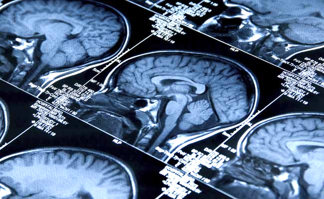 Rare-Brain-Disease.jpg