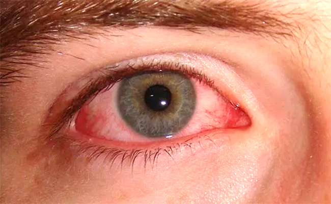 Conjunctivitis.jpg