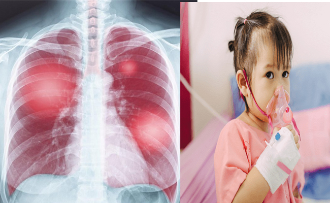 White_20Lung_20Syndrome.jpg