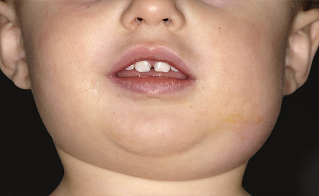 mumps.jpg
