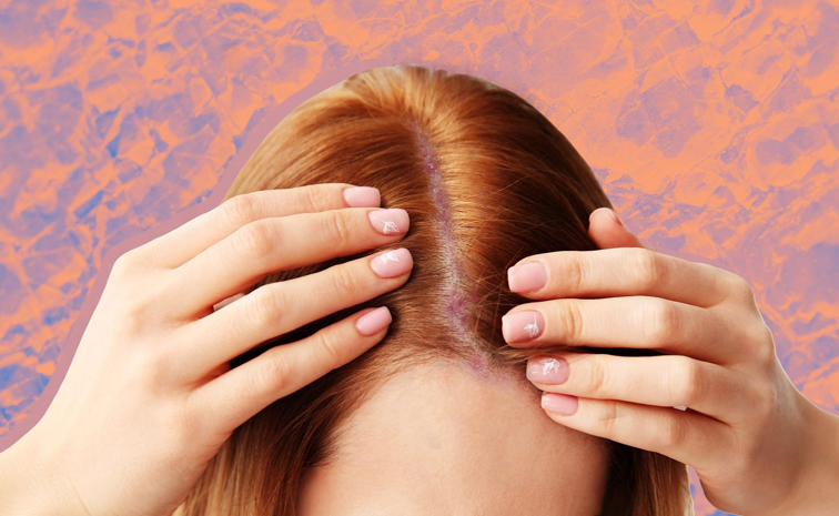 Psoriasis_Myths.jpg