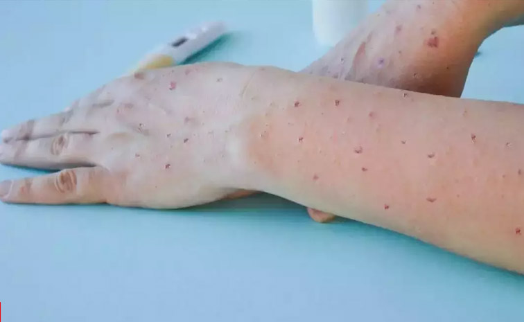 monkey-pox.jpg