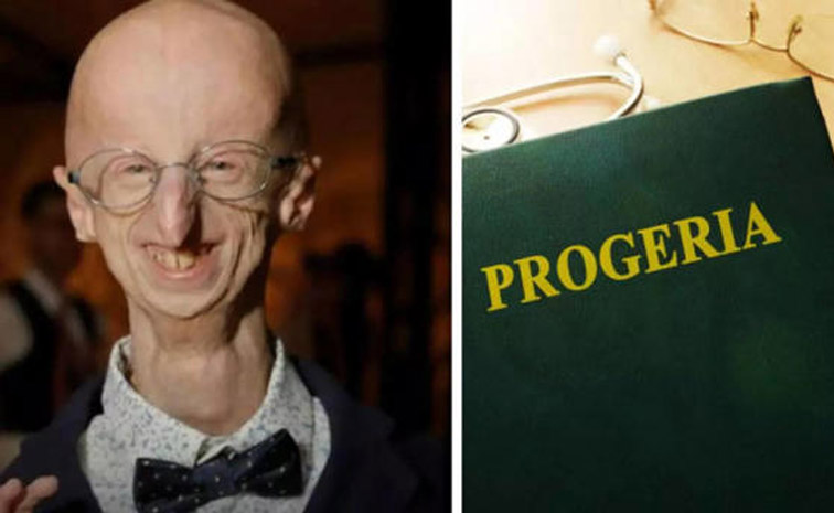 progeria.jpg