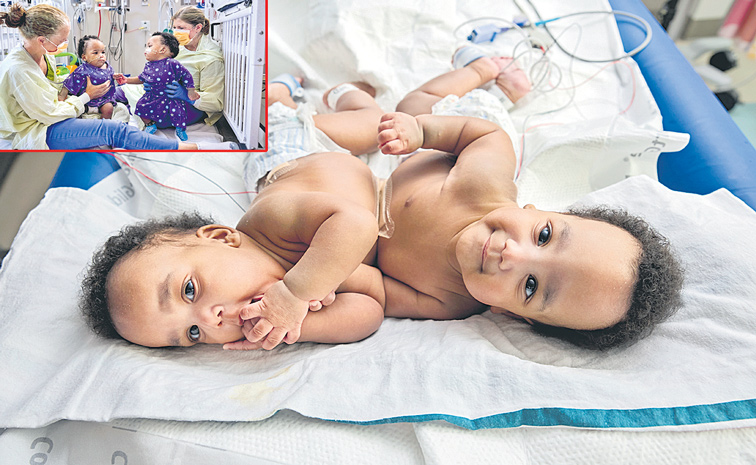 101020241133-CONJOINED-TWIN.jpg