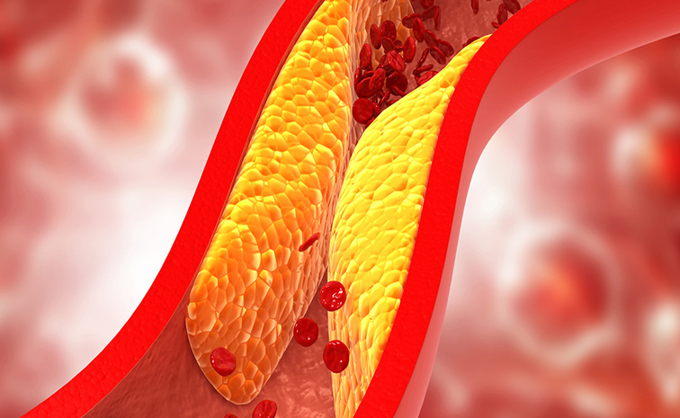 LDL_20cholesterol.jpg