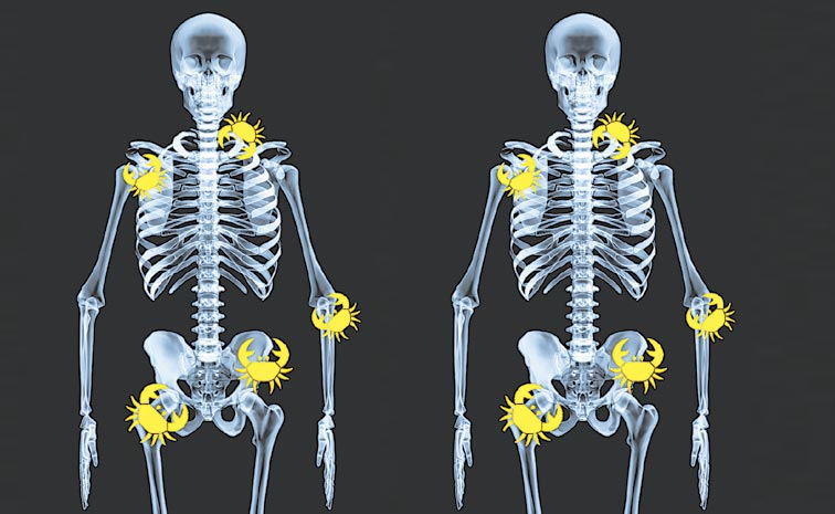 Bone-Cancer-Points.jpg