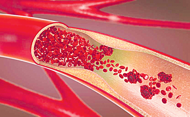 BLOODCLOT.jpg