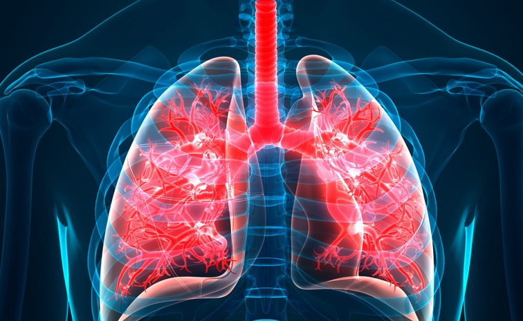 IdiopathicPulmonaryFibrosis.jpg