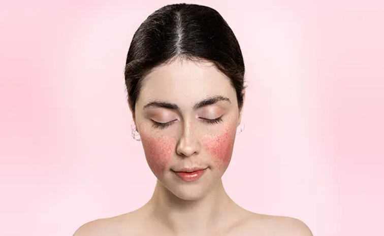 lupus.jpg