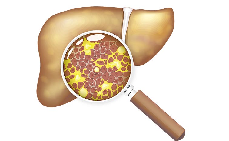 FATTY-LIVER_5D.jpg