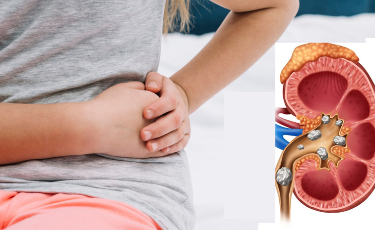 kidneystone.jpg