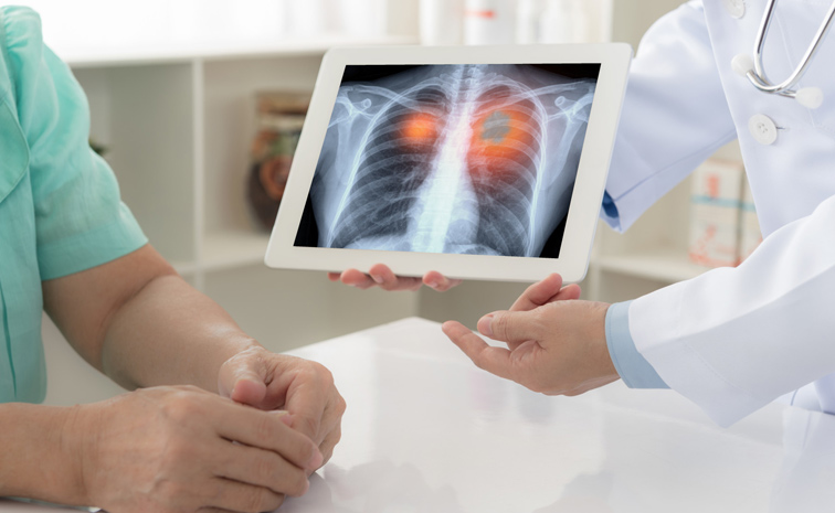 lungcancer.jpg