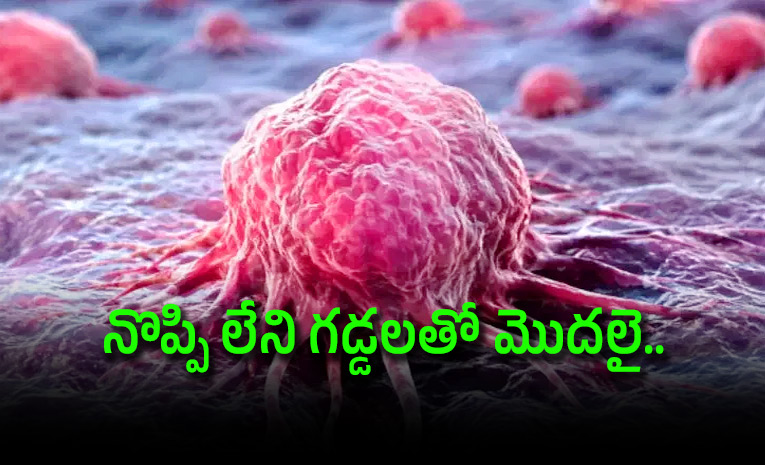 Sarcoma-Explained-the-Rare-Cancer-that-Often-Starts-as-a-Painless.jpg